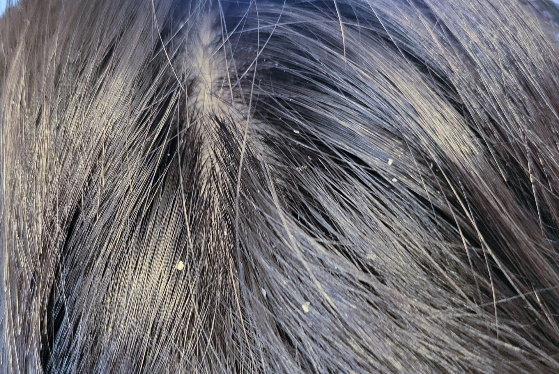 頭皮の痛みの原因は何でしょうか?