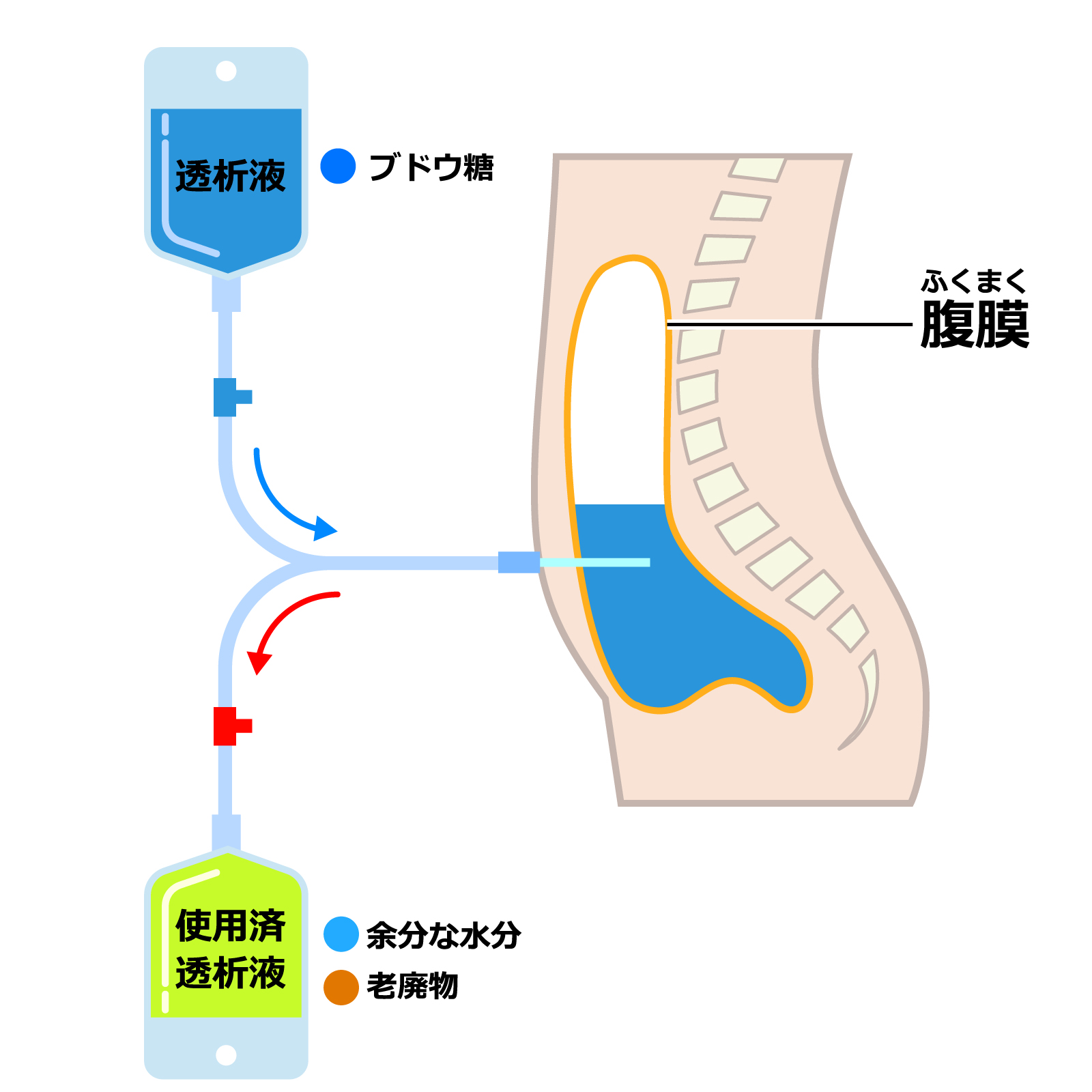 腹膜透析